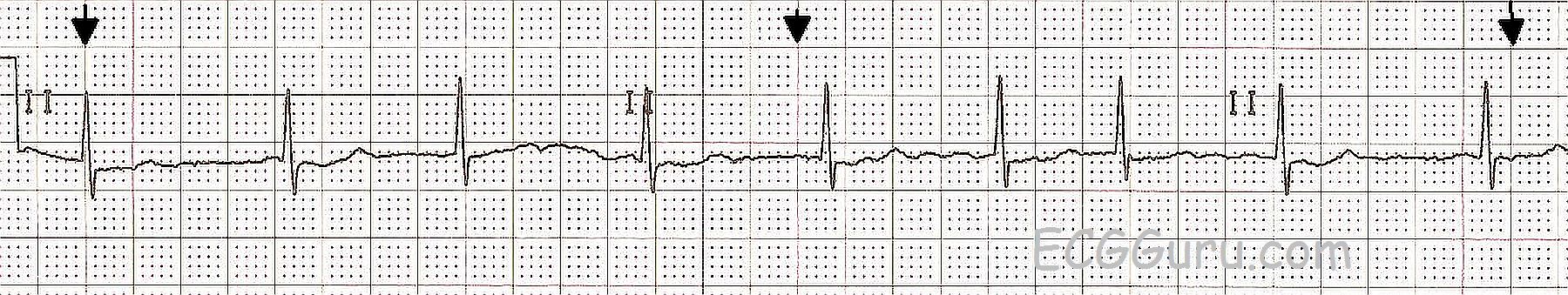 Ecg Basics Atrial Fibrillation With A Controlled Ventricular Response Ecg Guru Instructor